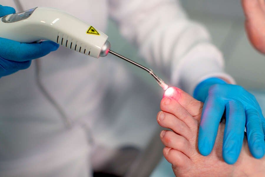 Procedimento de laserterapia aplicado ao cuidado dos pés